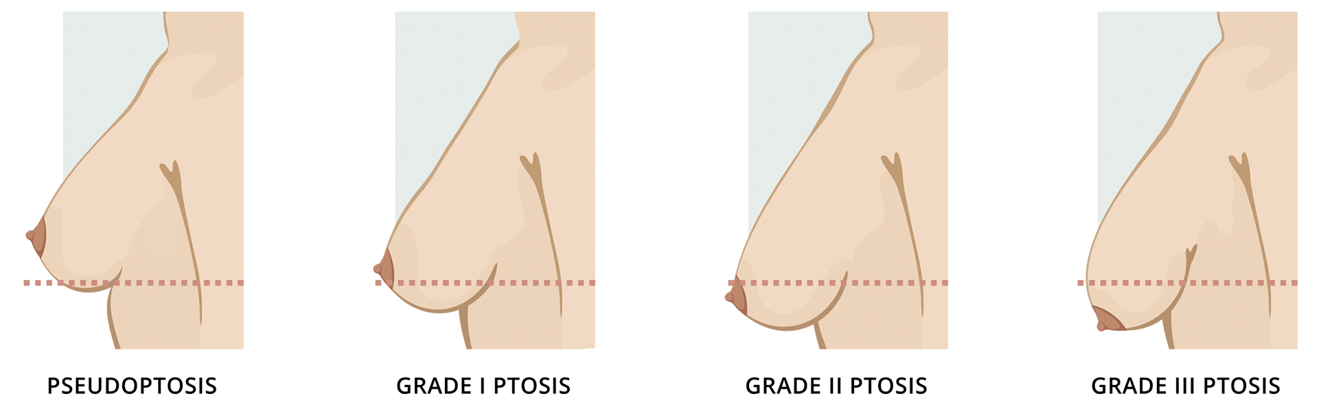 Sagging Breasts: Ptosis Of Breasts